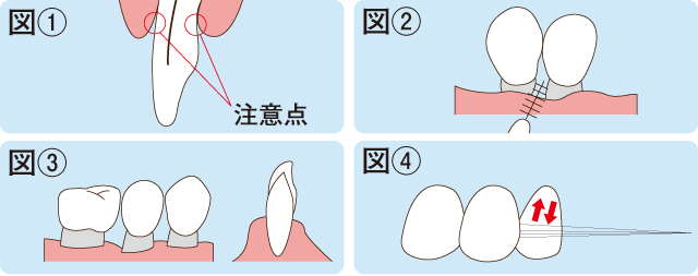 ライフステージに沿った予防とケア 壮年期～歯の喪失期～