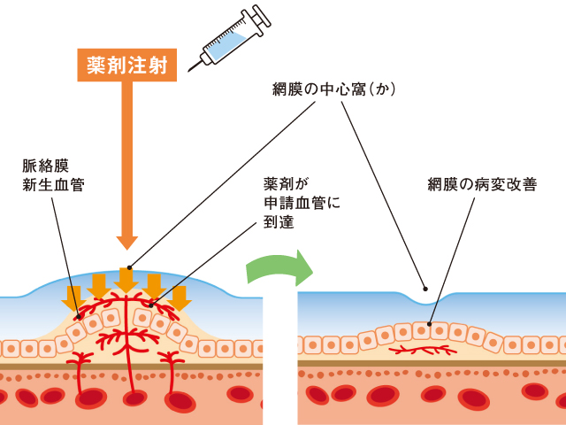 抗VEGF療法(硝子体“しょうしたい”注射