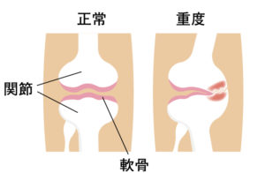 軟骨がすり減ると、動かしたときに痛みます